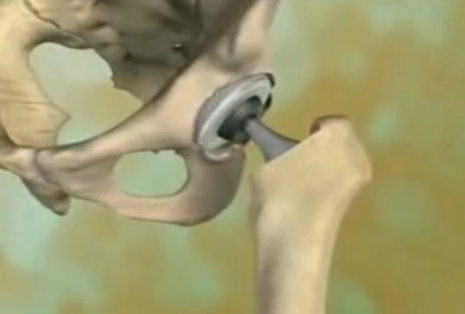 протезирование-тазобедренного-сустава